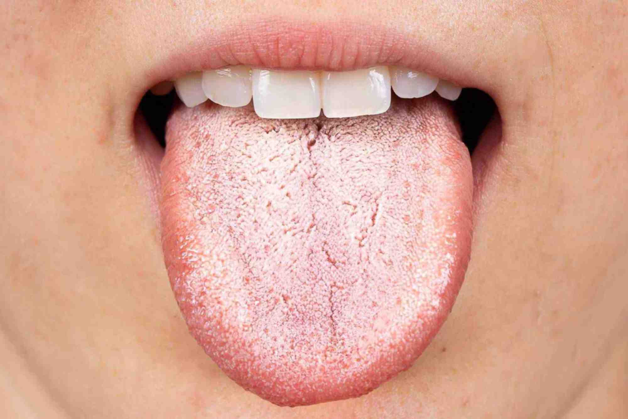 Preventing Vaper's Tongue